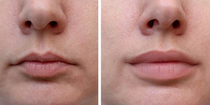 Hyaluronic Acid Filler 1ml