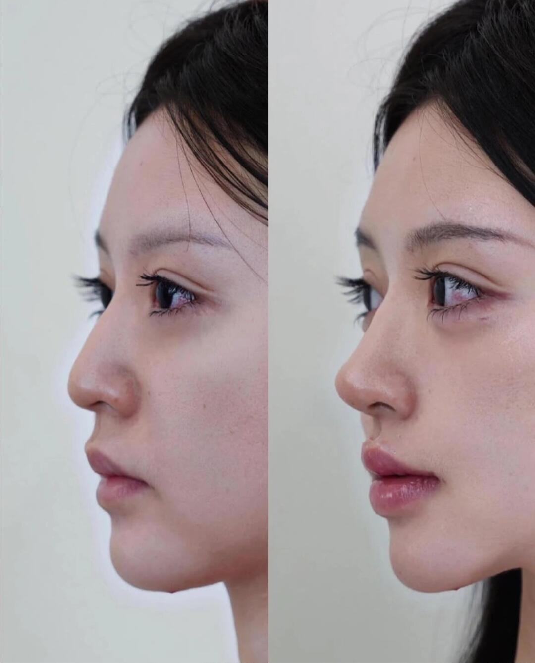 Hyaluronic Acid Filler 1ml