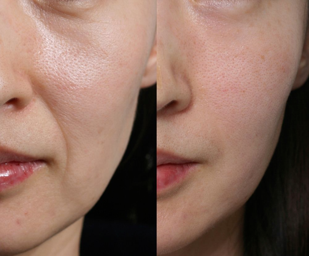 Hyaluronic Acid Filler 1ml