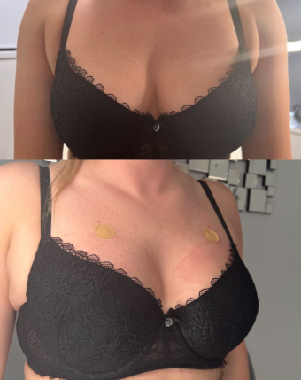 Hyaluronic Acid Filler 50ml